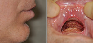 labiomental-fold-release-indianapolis-dr-barry-eppley