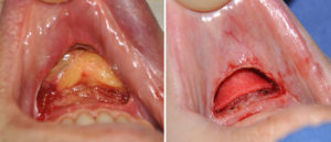 labiomental-fold-release-and-grafting-dr-barry-eppley-indianapolis