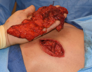 large-bacjk-lipoma-excision-dr-barry-eppley-indianapolis