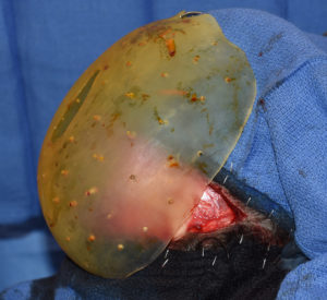 large-custom-skull-implant-intraop-dr-barry-eppley-indianapolis