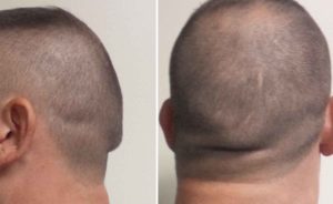occipital-knob-deformity-dr-barry-eppley-indianapolis