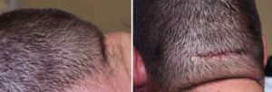 occipital-knob-reduction-incision-dr-barry-eppley-indianapolis