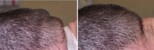 occipital-knob-reduction-intraop-result-dr-barry-eppley-indianapolis