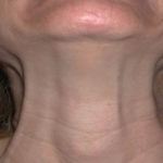 platysmal-neck-bands-dr-barry-eppley-indianapolis