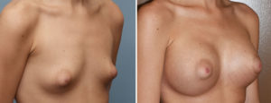 puffy-nipple-braest-augmentation-results-oblique-view-dr-barry-eppley-indianapolis