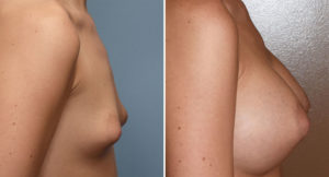 puffy-nipple-breast-augmentation-result-side-view-dr-barry-eppley-indianapolis