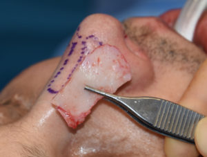 rhinoplasty-with-septal-cartilage-graft-dr-barry-eppley-indianapolis