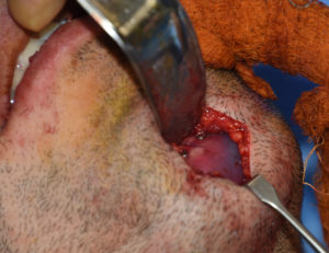 split-custom-jawline-implant-dr-barry-eplpey-indianapolis
