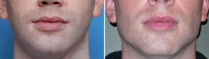 standard-chin-and-jaw-angle-implants-result-front-view-dr-barry-eppley-indianapolis