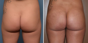 tb-buttock-implant-results-back-view-dr-barry-eppley-indianapolis