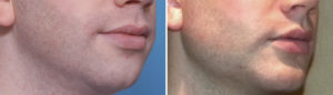 three-piece-chin-and-jaw-angle-implants-result-oblique-view-dr-barry-eppley-indianapolis