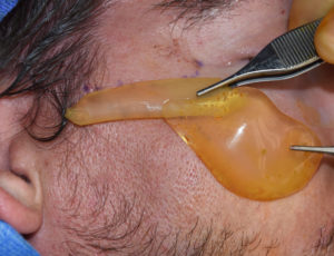 zygomatic-arch-implant-extension-off-of-cheek-implant-dr-barry-eppley-indianapolis