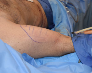 bicep-augmentation-by-fat-injections-dr-barry-eppley-indianapolis