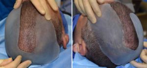 custom-skull-implant-for-skull-asymmetry-intraop-implant-dr-barry-eppley-indianapolis