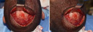 custom-skull-implant-for-skull-asymmetry-intraop-placement-dr-barry-eppley-indianapolis