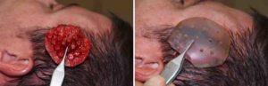 custom-temporal-implamnt-replacement-dr-barry-eppley-indianapolis