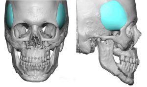 custom-temporal-implants-design-dr-barry-eppley-indianapolis