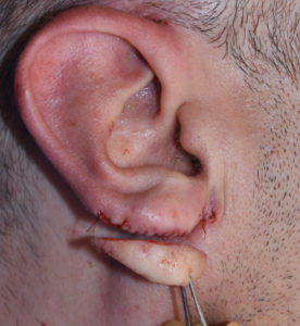 earlobe-reduction-dr-barry-eppley-indianapolis