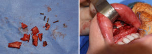 medpor-chin-implant-removal-and-sliding-genioplasty-replacement-intraop-dr-barry-eppley-indianapolis