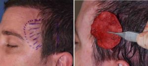 medpor-temporal-implant-removal-dr-barry-eppley-indianapolis