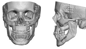 medpor-temporal-implants-dr-barry-eppley-indianapolis