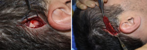 posterior-temporal-reduction-by-muscle-removal-dr-barry-eppley-indianapolis