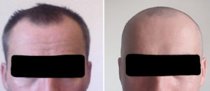 posterior-temporal-reduction-result-front-view-dr-barry-eppley-indianapolis