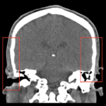 posterior-temporla-muscle-thickness