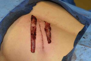 rib-removals-for-chronic-rib-pain-dr-barry-eppley-indianapolis