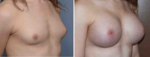 ar-bam-result-oblique-view