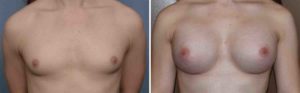 ar-bam-results-front-view