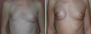 breast-implant-reconstruction-in-polands-sundrome-result-front-view-dr-barry-eppley-indianapolis