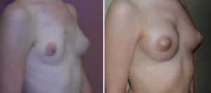 breast-implant-reconstruction-in-polands-syndrome-result-oblique-view-dr-barry-eppley-indianapolis