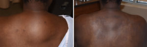 buffalo-hump-reduction-result-back-view-dr-barry-eppley-indianapolis