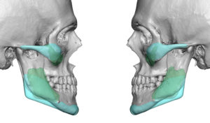 cheek-and-jaw-angle-implant-exchange-2-dr-barry-eppley-indianapolis