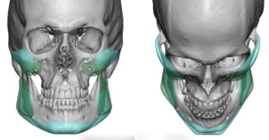 cheek-and-jaw-angle-implant-exchange-dr-barry-eppley-indianapolis