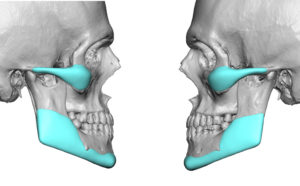 custom-cheek-and-jaw-angle-implant-designs-2-dr-barry-eppley-indianapolis