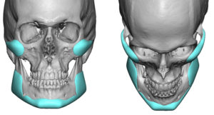 custom-cheek-and-jaw-angle-implant-designs-dr-barry-eppley-indianapolis
