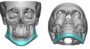 custom-jawline-implant-replacement-for-malpositioned-jaw-angle-implants-front-view-dr-barry-eppley-indianapolis