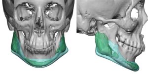 custom-jawline-implant-replacement-for-malpositioned-jaw-angle-implants-overlay-dr-barry-eppley-indianapolis