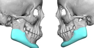 custom-jawline-implant-replacement-for-mapositioned-jaw-angle-implants-side-view-dr-barry-eppley-indianapolis