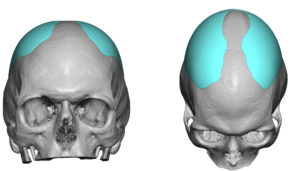 custom-skull-implant-design-for-sagittal-ridge-deformity-dr-barry-eppley-indianapolis