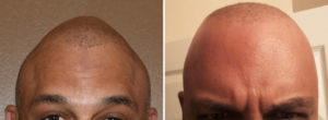 custom-skull-implant-results-front-view-dr-barry-eppley-indianapolis