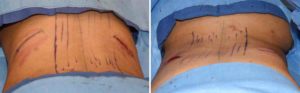 effects-of-rib-removal-for-waistline-narrowing-intraop-dr-barry-eppley-indianapolis
