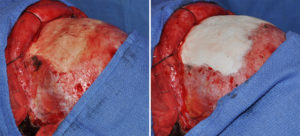 forehead-augmentation-with-hydroxyapatite-cement-intraop-dr-barry-eppley-indianapolis