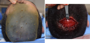 heightening-skull-implant-placement-dr-barry-eppley-indianapolis