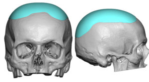 heightening-skull-implant-design-dr-barry-eppley-indianapolis