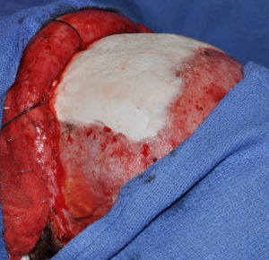 hydroxyapatite-cement-forehead-augmentation-dr-barry-eppley-indianapolis