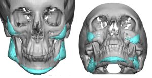 malpositioned-jaw-angle-implants-2