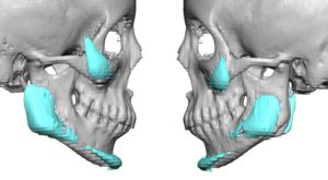 malpositioned-jaw-angle-implants